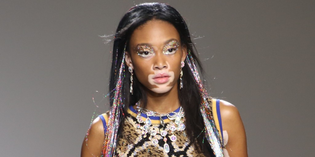 Winnie harlow vitiligo